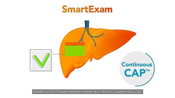 FibroScanά˲ʱԲⶨӭܻ£SmartExamϵͳƽٴάʹ