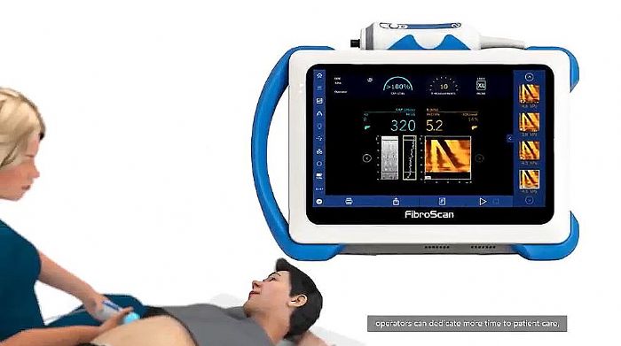 FibroScanά˲ʱԲⶨӭܻ£SmartExamϵͳƽٴάʹ