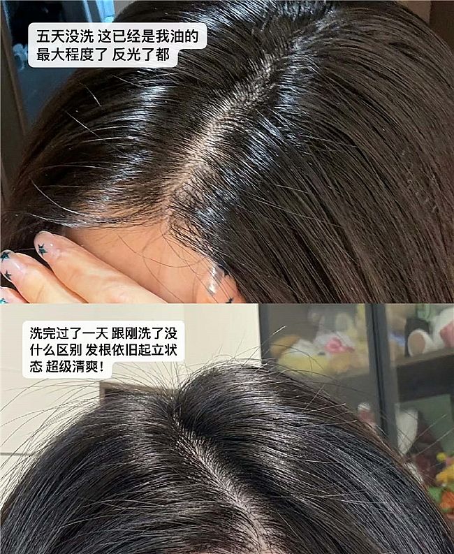 2026�Ƽ�:��ôȥ��ͷ�ϵ�ͷƤм��ϴͷ��ȥмֹ�������ĸ���